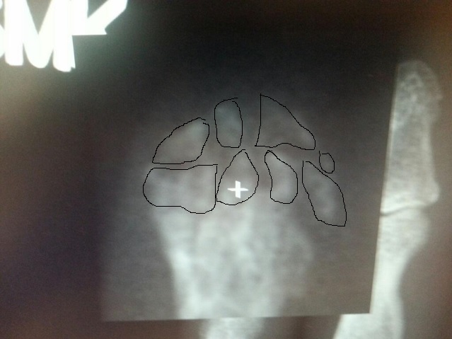 Tip of my left ring finger X-ray - Detailed